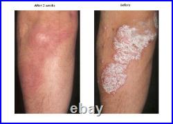 110-240V 12W Psoriasis Eczema light therapy lamp + Psoralen cream