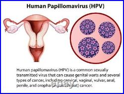 Chlamydia Gonorrhea Hpv Treat & Prevent Men & Women