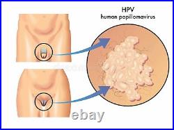 Chlamydia Gonorrhea Hpv Treat & Prevent Men & Women