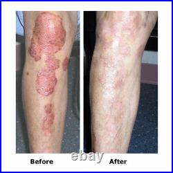 DermaHealer UVB Lampe gegen Psoriasis Schuppenflechte Vitiligo Ekzem 311Nm NEU