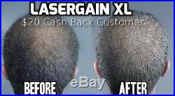 Laser Comb Hair Growth Loss Regrowth Treatment (28x More Power Than Others!)