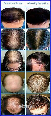 Potable Laser Cap for Hair regrowth, FDA cleared, Laser therapy for hair loss