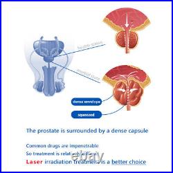 Profession Prostate Laser Therapy Device Dysuria Nocturia Frequently Prostatitis