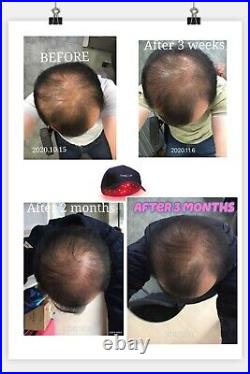 US PRO 272 Laser Cap, FDA Cleared Hair Regrowth Laser Cap LLLT, Hair Loss