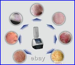 UV Phototheray Home UVB Light Therapy for Psoriasis Vitiligo Eczema others