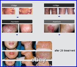 UV Phototheray Home UVB Light Therapy for Psoriasis Vitiligo Eczema others Skin