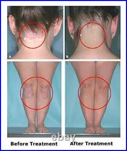 Uvb 311nm Hand-held Lamp Psoriasis, Vitiligo, Eczema, Dermatitis! Phototherapy