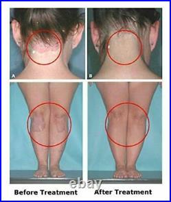 Uvb Lampe Psoriasis, Schuppenflechte, Vitiligo, Eczema! Lichttherapie 311nm Acne