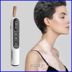 Uvb light therapy 308nm small area vitiligo